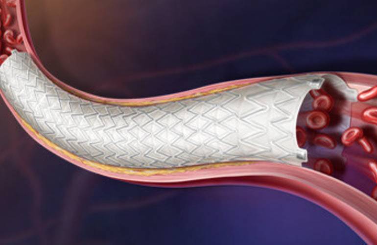 BD receives CE mark approval for Revello vascular covered stent