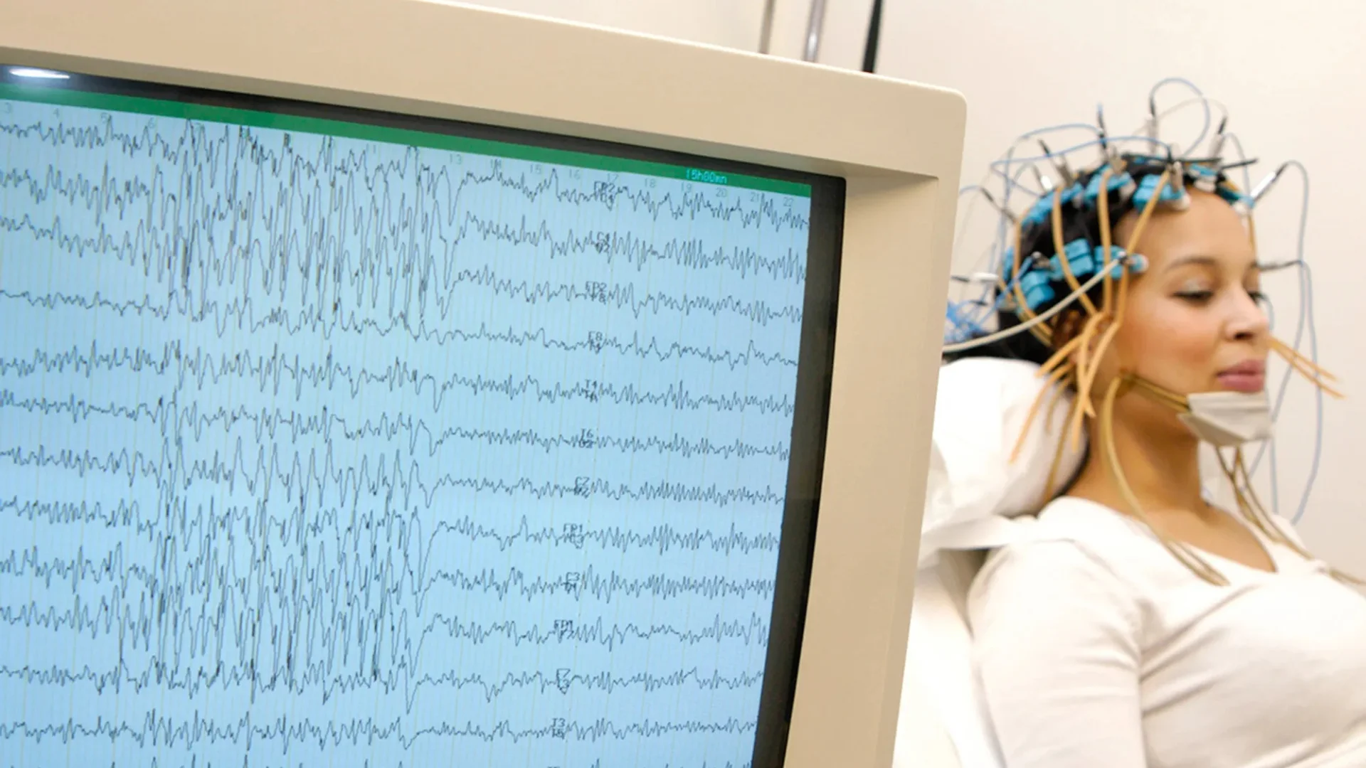 Gui Ystem AI Interface Cuts Epilepsy False Alarms by 80% | Voice of Healthcare